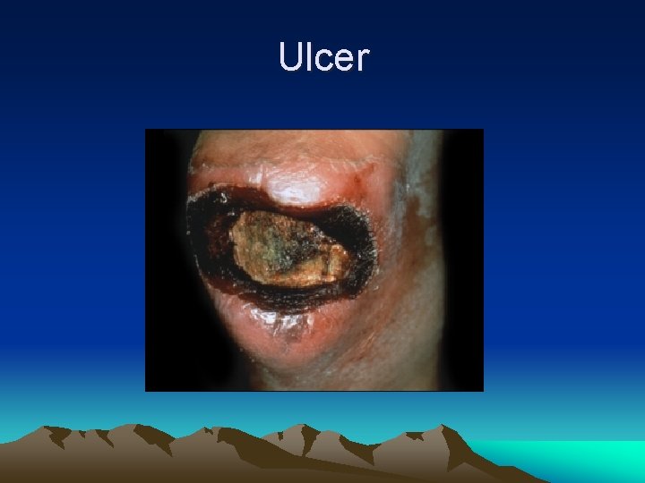 Ulcer 