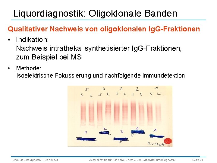 Liquordiagnostik: Oligoklonale Banden Qualitativer Nachweis von oligoklonalen Ig. G-Fraktionen • Indikation: Nachweis intrathekal synthetisierter