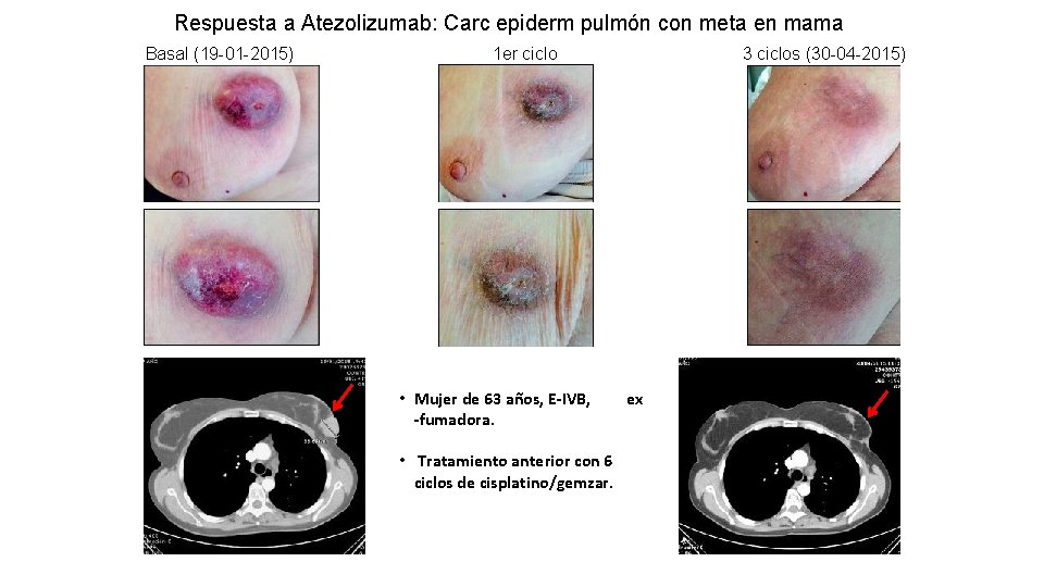 Respuesta a Atezolizumab: Carc epiderm pulmón con meta en mama Basal (19 -01 -2015)