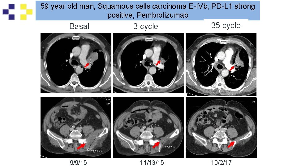 59 year old man, Squamous cells carcinoma E-IVb, PD-L 1 strong positive, Pembrolizumab Basal