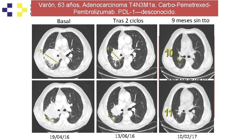 Varón, 63 años, Adenocarcinoma T 4 N 3 M 1 a, Carbo-Pemetrexed. Pembrolizumab. PDL-1—desconocido.