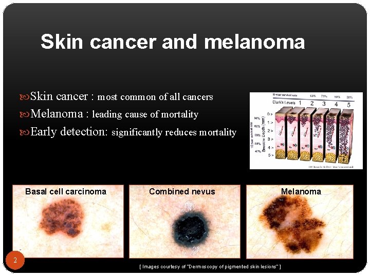 Skin cancer and melanoma Skin cancer : most common of all cancers Melanoma :