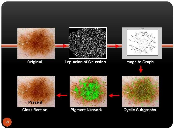 Original Laplacian of Gaussian Image to Graph Pigment Network Cyclic Subgraphs Present Classification 29