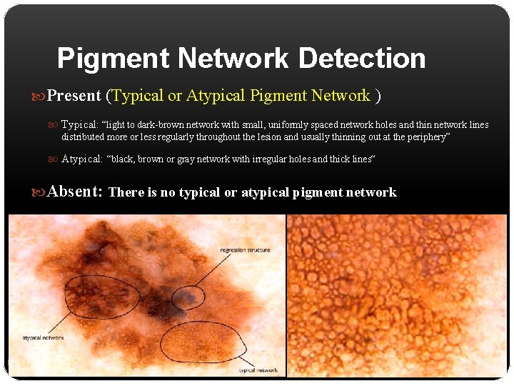 Pigment Network Detection Present (Typical or Atypical Pigment Network ) Typical: “light to dark-brown