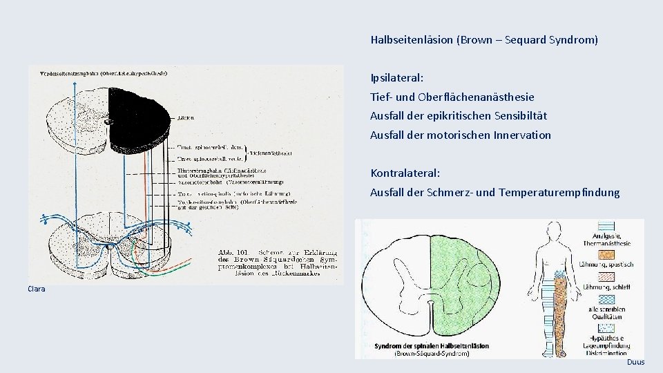 Halbseitenläsion (Brown – Sequard Syndrom) Ipsilateral: Tief- und Oberflächenanästhesie Ausfall der epikritischen Sensibiltät Ausfall