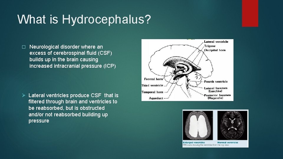 What is Hydrocephalus? � Neurological disorder where an excess of cerebrospinal fluid (CSF) builds