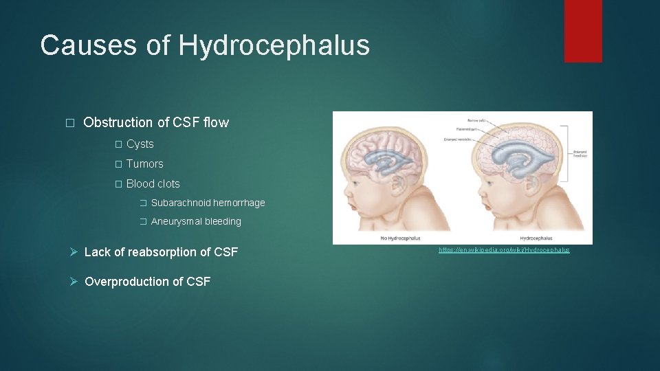 Causes of Hydrocephalus � Obstruction of CSF flow � Cysts � Tumors � Blood
