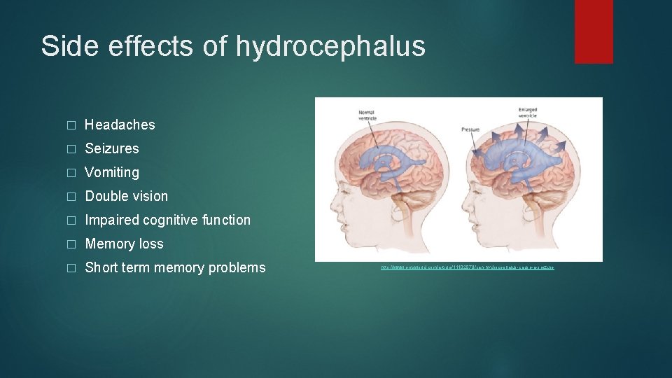 Side effects of hydrocephalus � Headaches � Seizures � Vomiting � Double vision �