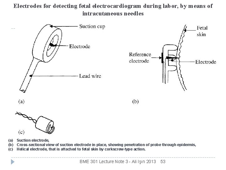 Electrodes for detecting fetal electrocardiogram during labor, by means of intracutaneous needles (a) Suction