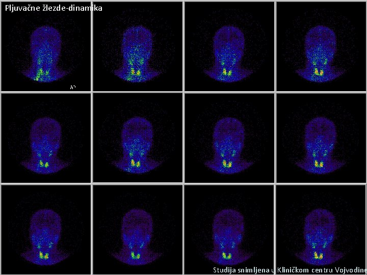 Pljuvačne žlezde-dinamika Studija snimljena u Kliničkom centru Vojvodine 