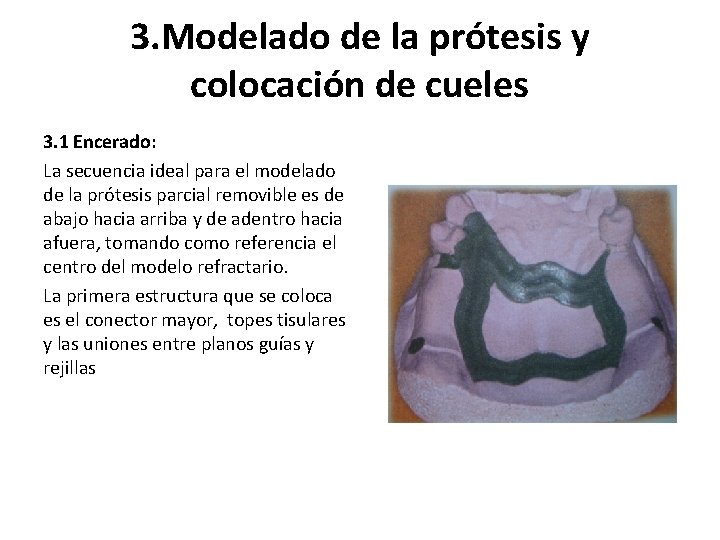 3. Modelado de la prótesis y colocación de cueles 3. 1 Encerado: La secuencia