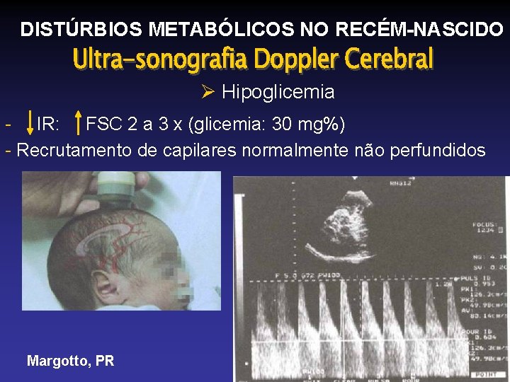 DISTÚRBIOS METABÓLICOS NO RECÉM-NASCIDO Ø Hipoglicemia - IR: FSC 2 a 3 x (glicemia: