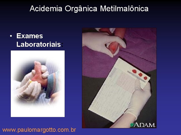 Acidemia Orgânica Metilmalônica • Exames Laboratoriais: www. paulomargotto. com. br 
