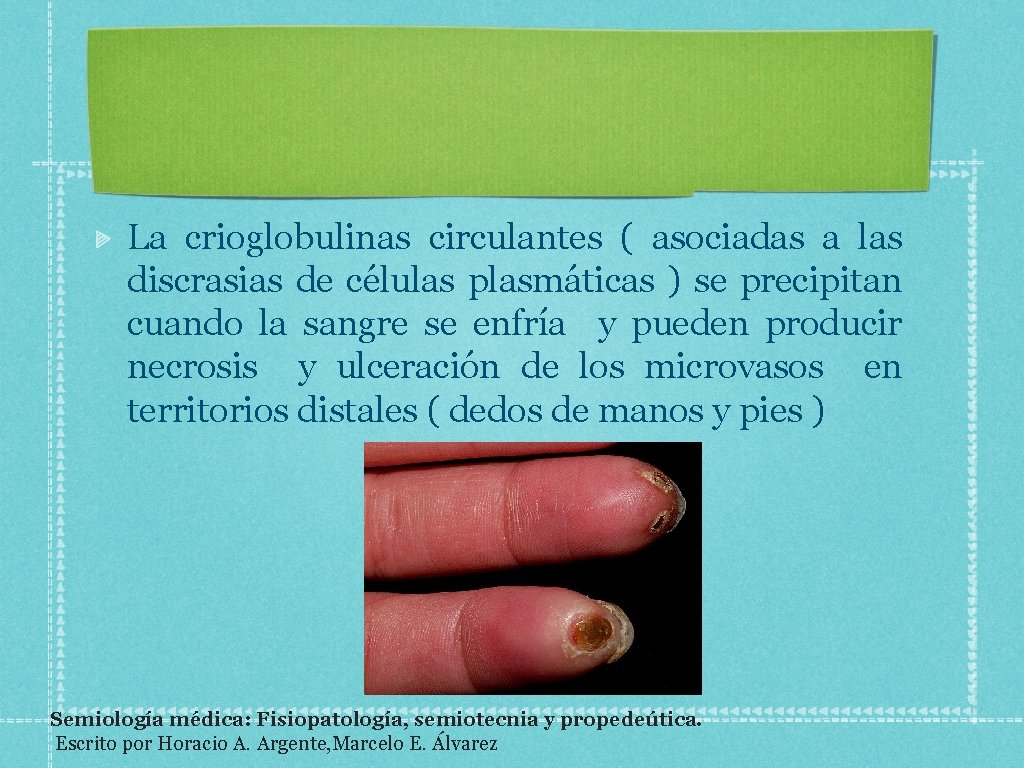 La crioglobulinas circulantes ( asociadas a las discrasias de células plasmáticas ) se precipitan