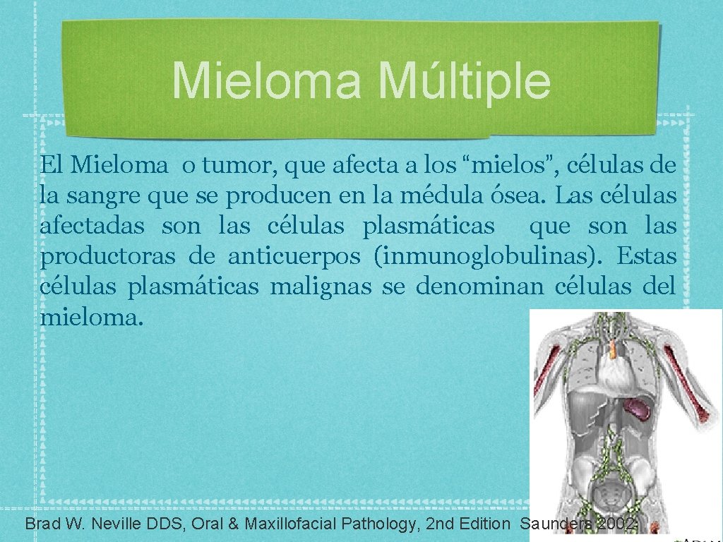 Mieloma Múltiple El Mieloma o tumor, que afecta a los “mielos”, células de la