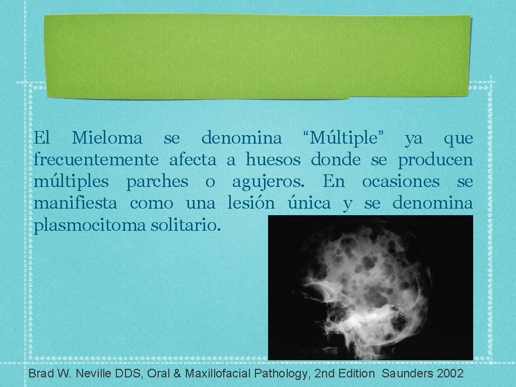 El Mieloma se denomina “Múltiple” ya que frecuentemente afecta a huesos donde se producen