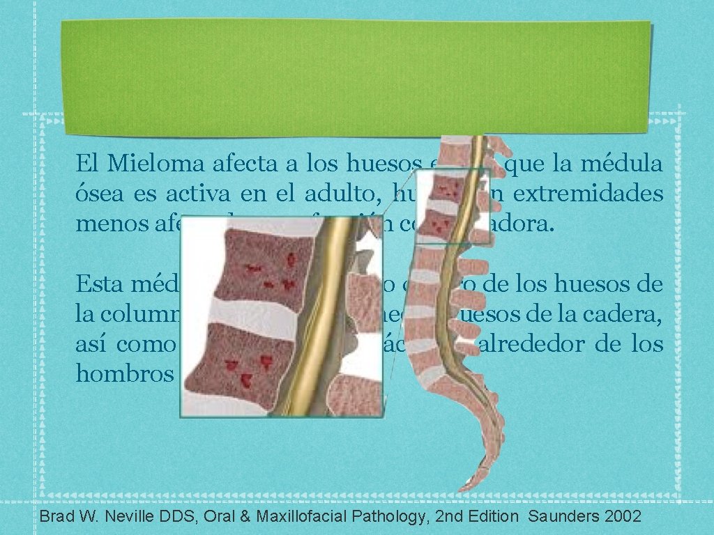 El Mieloma afecta a los huesos en los que la médula ósea es activa
