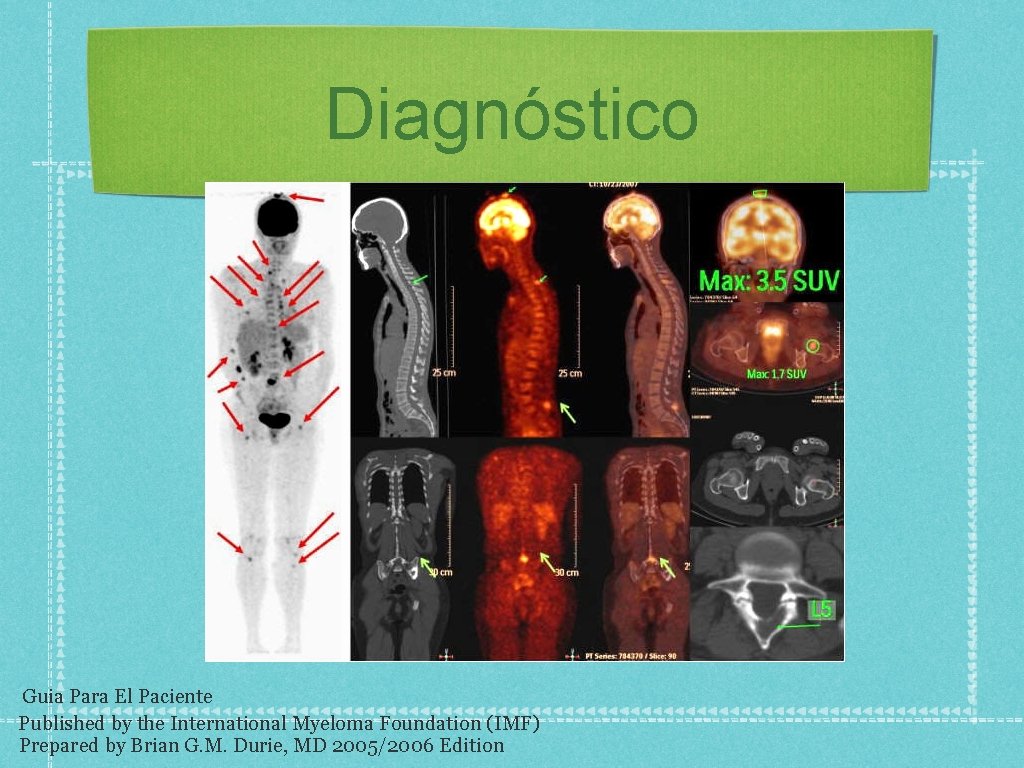 Diagnóstico Guia Para El Paciente Published by the International Myeloma Foundation (IMF) Prepared by