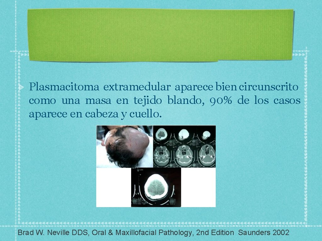 Plasmacitoma extramedular aparece bien circunscrito como una masa en tejido blando, 90% de los