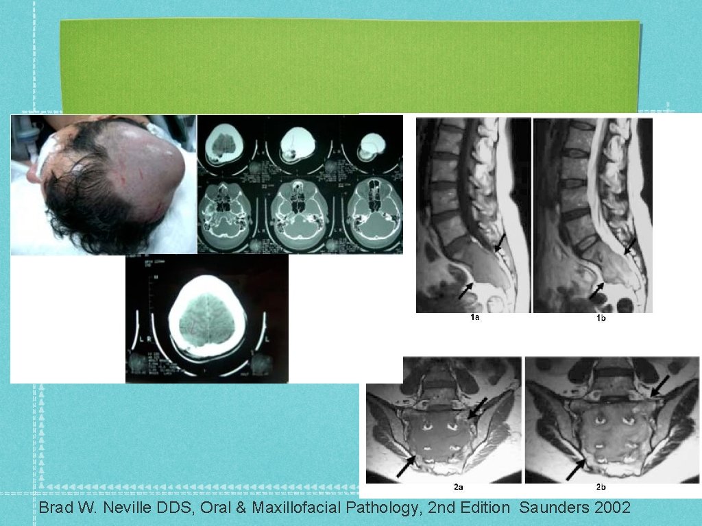 Radiográficamente se observa como una lesión radiolucente unilocular similar al mieloma. Brad W. Neville