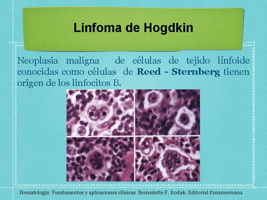 Linfoma de Hogdkin Neoplasia maligna de células de tejido línfoide conocidas como células de