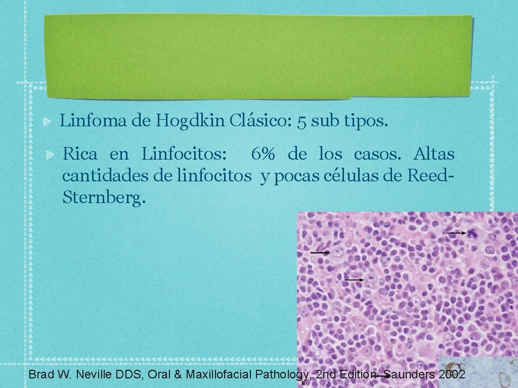 Linfoma de Hogdkin Clásico: 5 sub tipos. Rica en Linfocitos: 6% de los casos.