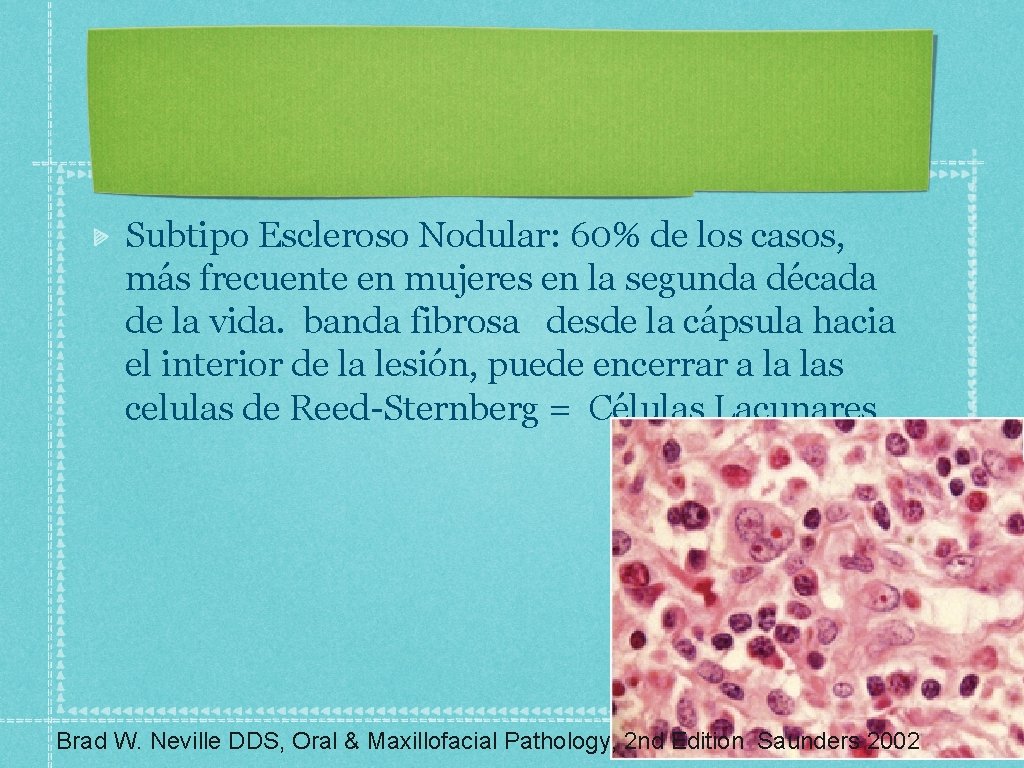 Subtipo Escleroso Nodular: 60% de los casos, más frecuente en mujeres en la segunda