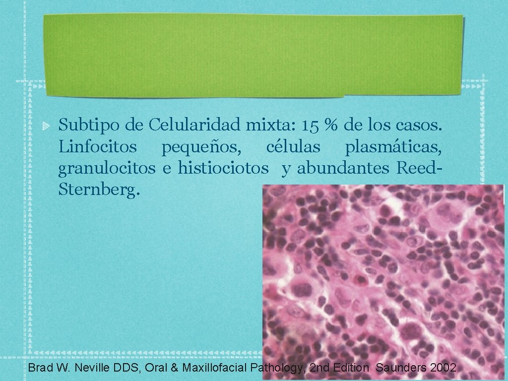 Subtipo de Celularidad mixta: 15 % de los casos. Linfocitos pequeños, células plasmáticas, granulocitos