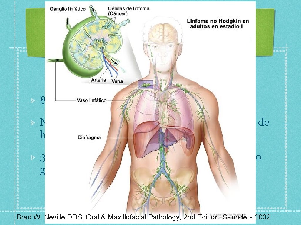 85 % de neoplasias de tejido linfoide. Neoplasias originadas de células T son raras