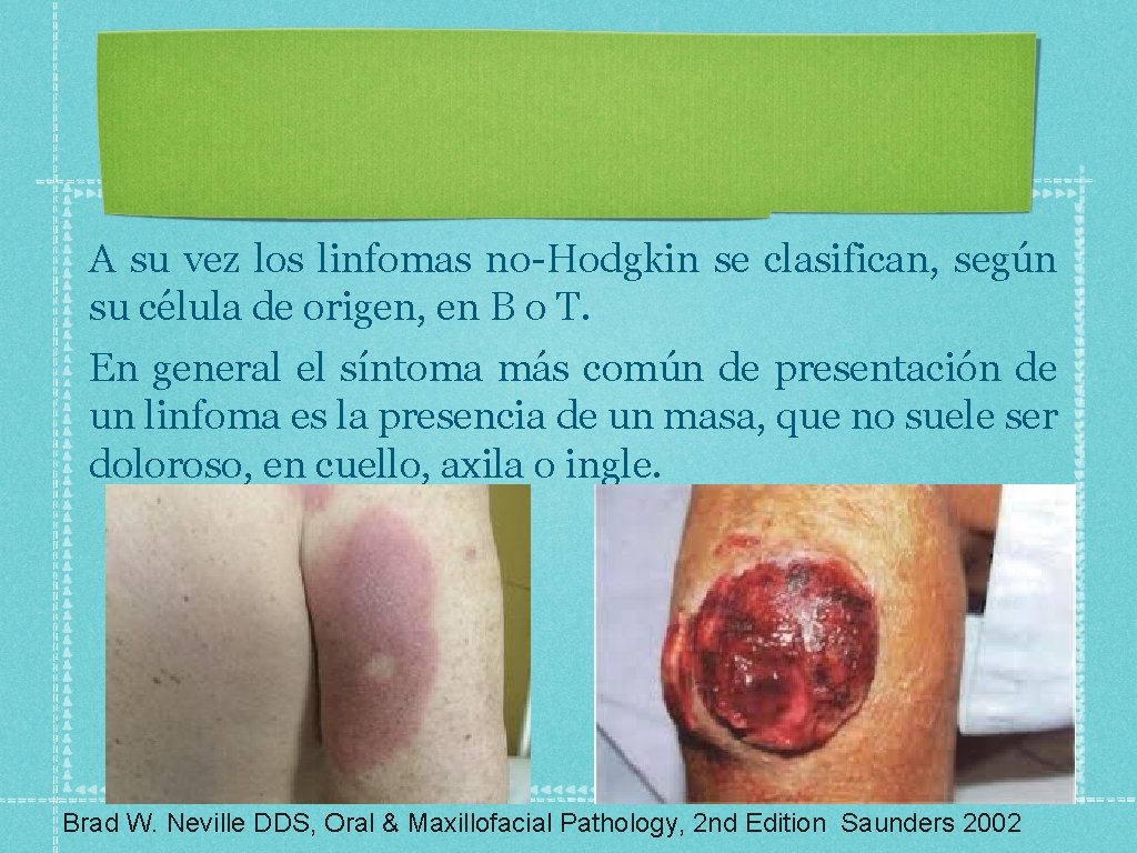 A su vez los linfomas no-Hodgkin se clasifican, según su célula de origen, en