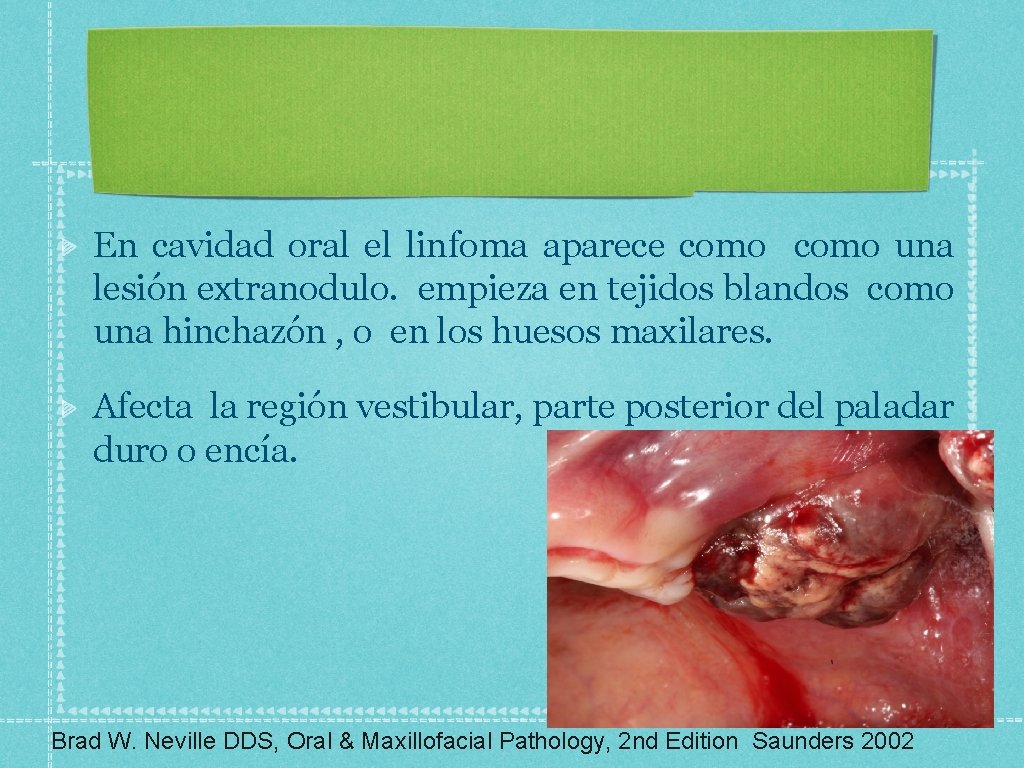 En cavidad oral el linfoma aparece como una lesión extranodulo. empieza en tejidos blandos