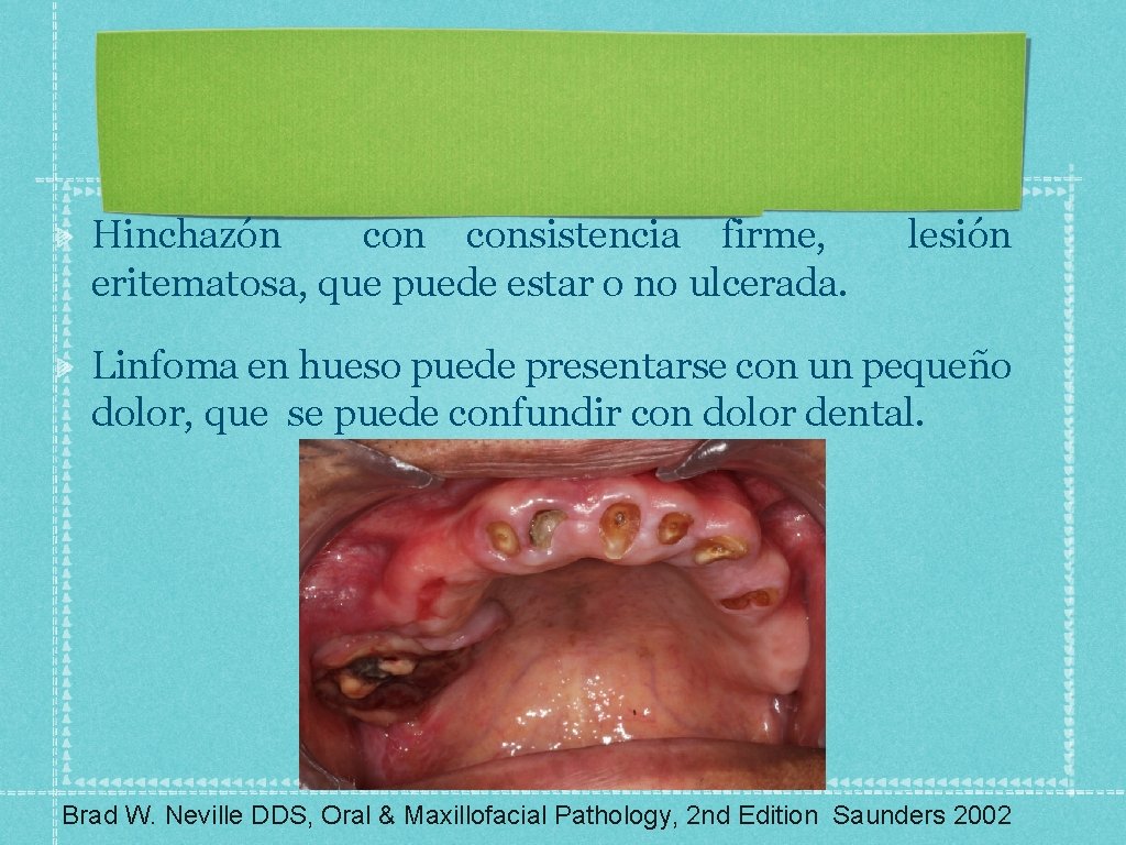 Hinchazón consistencia firme, lesión eritematosa, que puede estar o no ulcerada. Linfoma en hueso