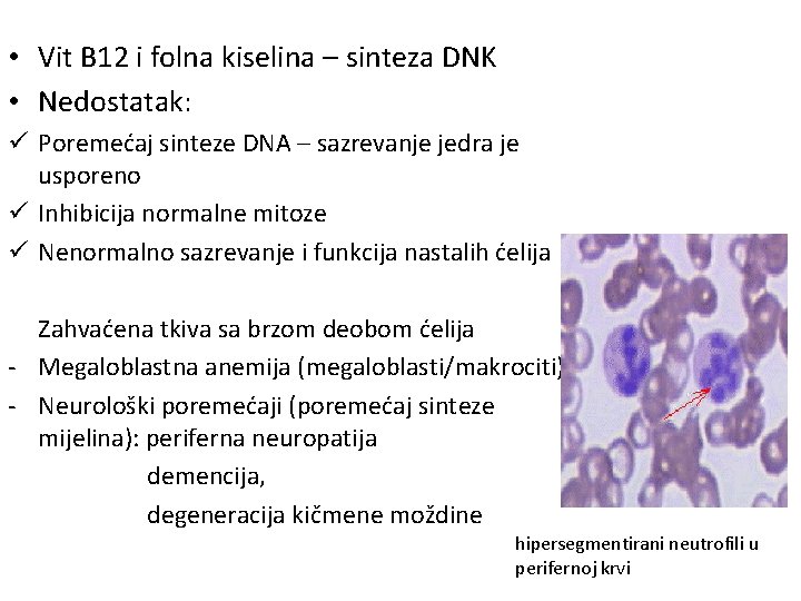  • Vit B 12 i folna kiselina – sinteza DNK • Nedostatak: ü