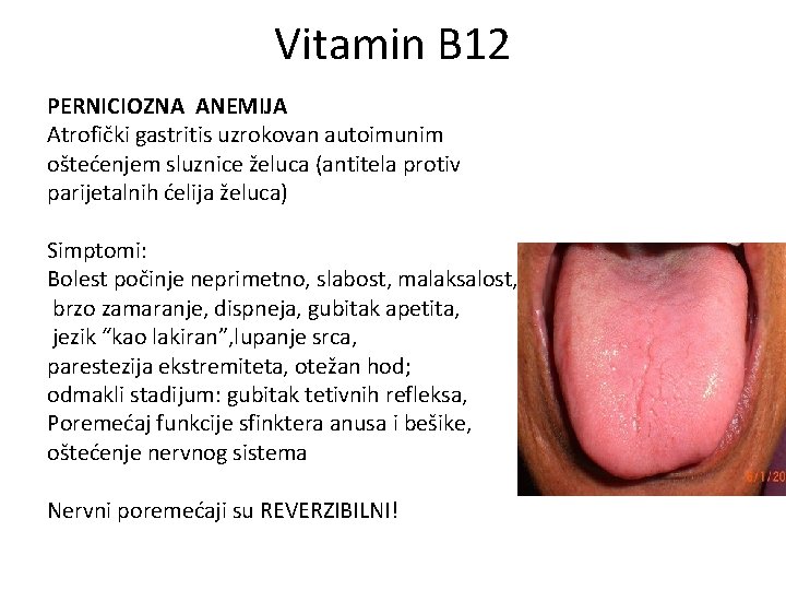 Vitamin B 12 PERNICIOZNA ANEMIJA Atrofički gastritis uzrokovan autoimunim oštećenjem sluznice želuca (antitela protiv