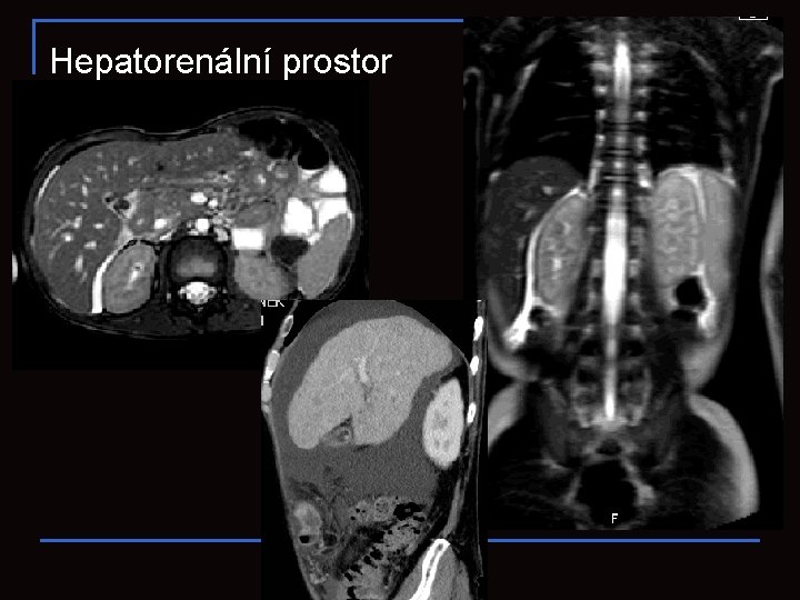 Hepatorenální prostor 