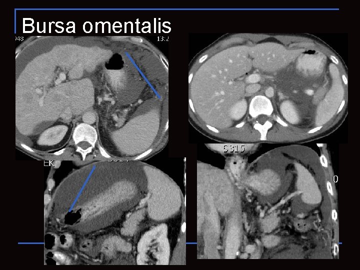 Bursa omentalis 