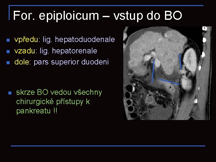 For. epiploicum – vstup do BO n n vpředu: lig. hepatoduodenale vzadu: lig. hepatorenale