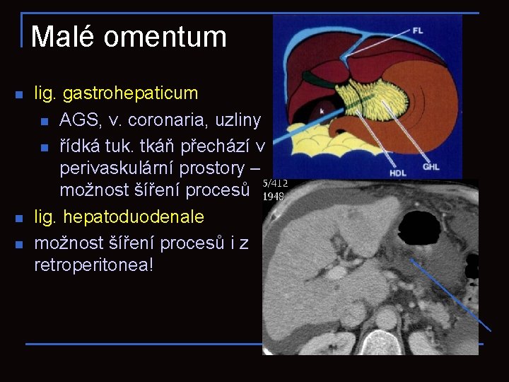 Malé omentum n n n lig. gastrohepaticum n AGS, v. coronaria, uzliny n řídká