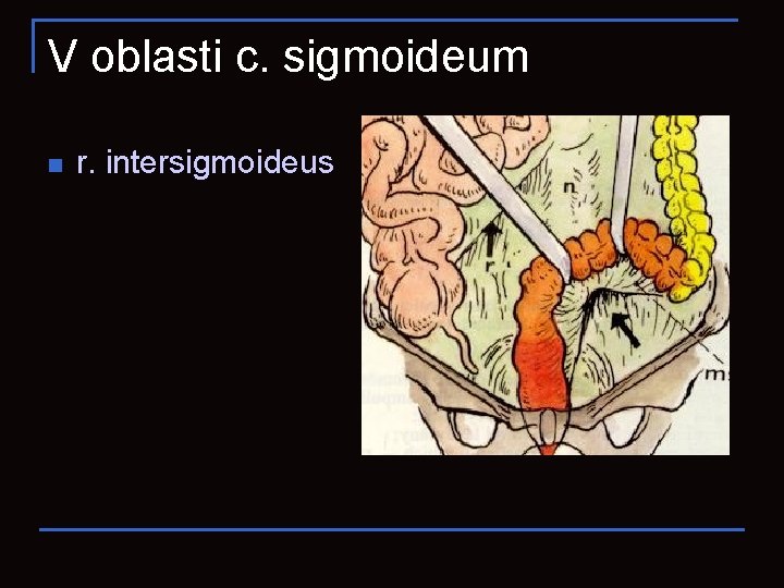 V oblasti c. sigmoideum n r. intersigmoideus 
