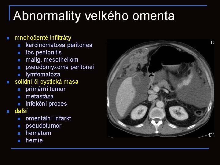 Abnormality velkého omenta n n n mnohočenté infiltráty n karcinomatosa peritonea n tbc peritonitis