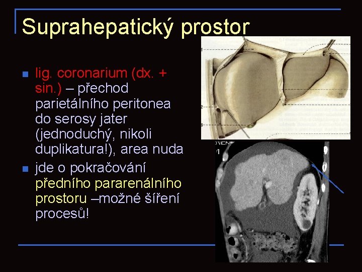 Suprahepatický prostor n n lig. coronarium (dx. + sin. ) – přechod parietálního peritonea