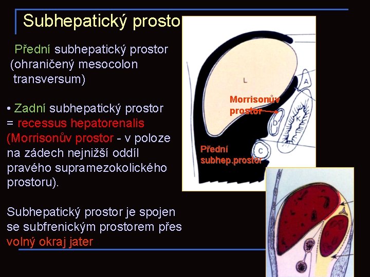 Subhepatický prostor • Přední subhepatický prostor (ohraničený mesocolon transversum) • Zadní subhepatický prostor =