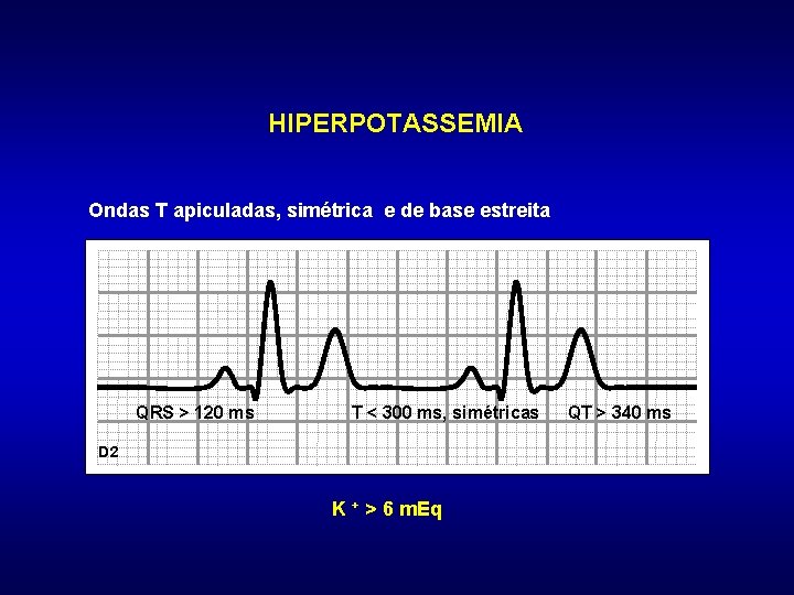 HIPERPOTASSEMIA Ondas T apiculadas, simétrica e de base estreita QRS > 120 ms T