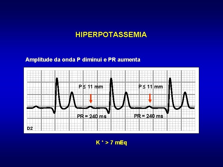 HIPERPOTASSEMIA Amplitude da onda P diminui e PR aumenta P ≤ 11 mm PR