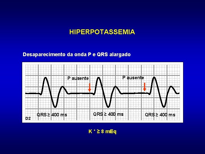 HIPERPOTASSEMIA Desaparecimento da onda P e QRS alargado P ausente D 2 QRS ≥