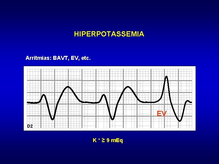 HIPERPOTASSEMIA Arritmias: BAVT, EV, etc. EV D 2 K + ≥ 9 m. Eq