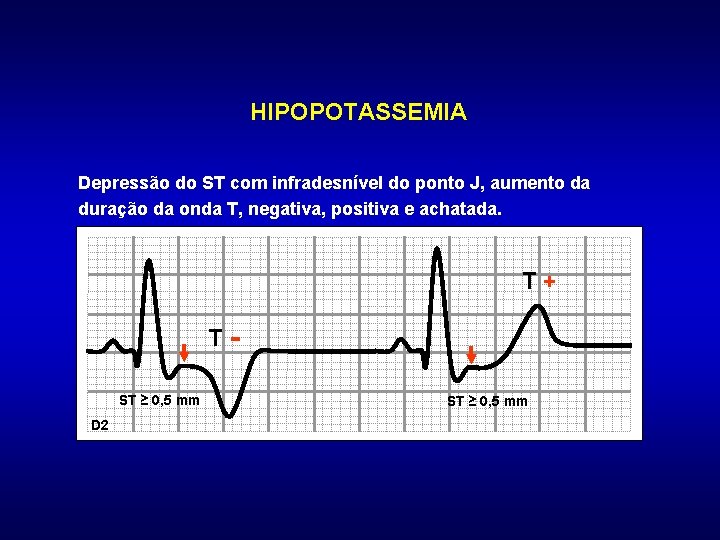 HIPOPOTASSEMIA Depressão do ST com infradesnível do ponto J, aumento da duração da onda