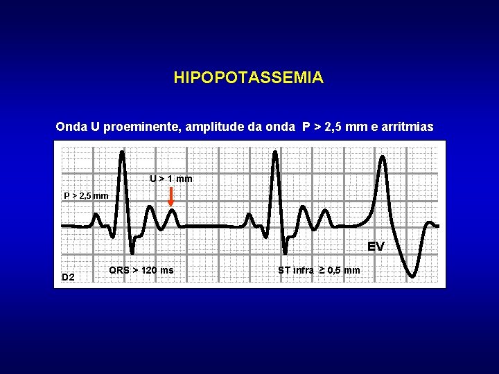 HIPOPOTASSEMIA Onda U proeminente, amplitude da onda P > 2, 5 mm e arritmias