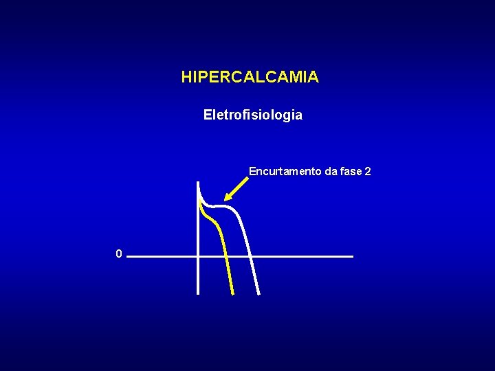 HIPERCALCAMIA Eletrofisiologia Encurtamento da fase 2 0 