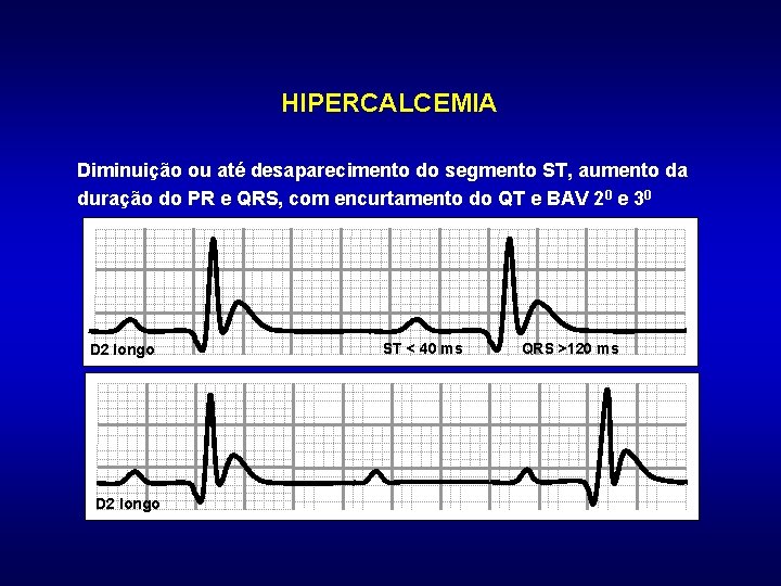 HIPERCALCEMIA Diminuição ou até desaparecimento do segmento ST, aumento da duração do PR e